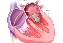 Balloon Valvuloplasty